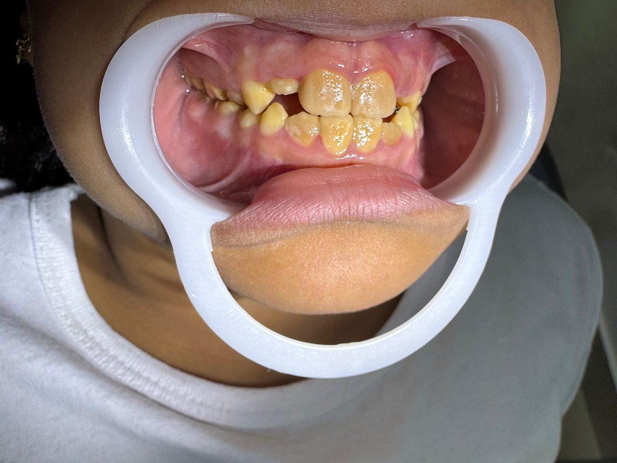 Young dental patient showing their discolored teeth