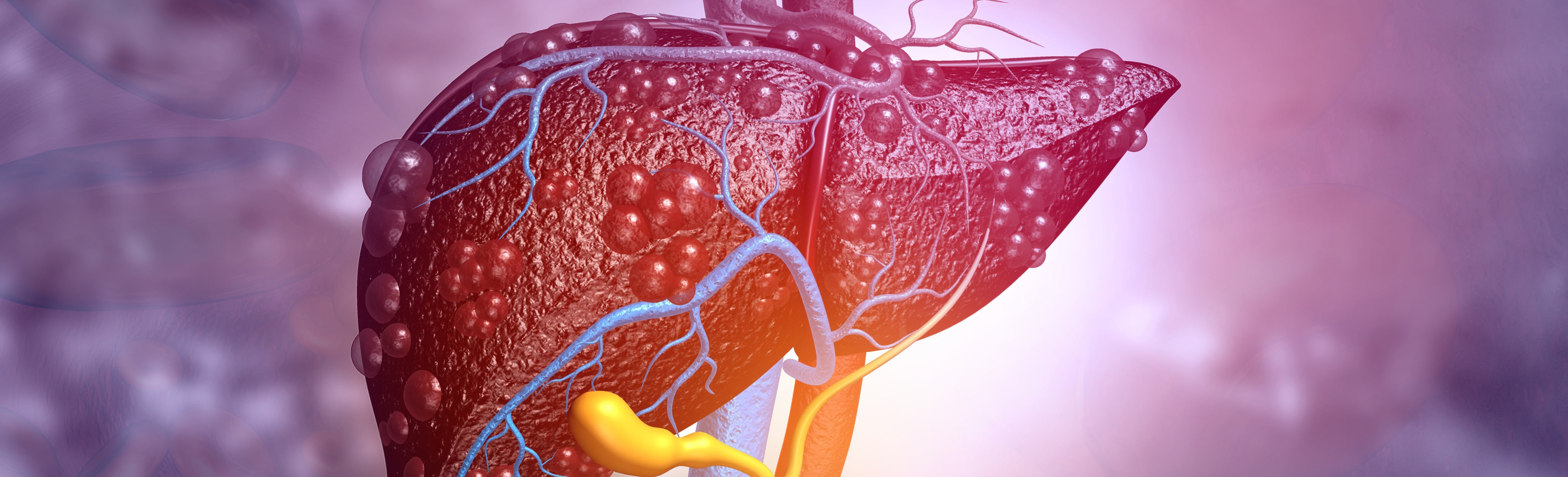tirzepatide liver disease Ever-Rising Fatty Liver Disease Gets Its First Drug and a New Name