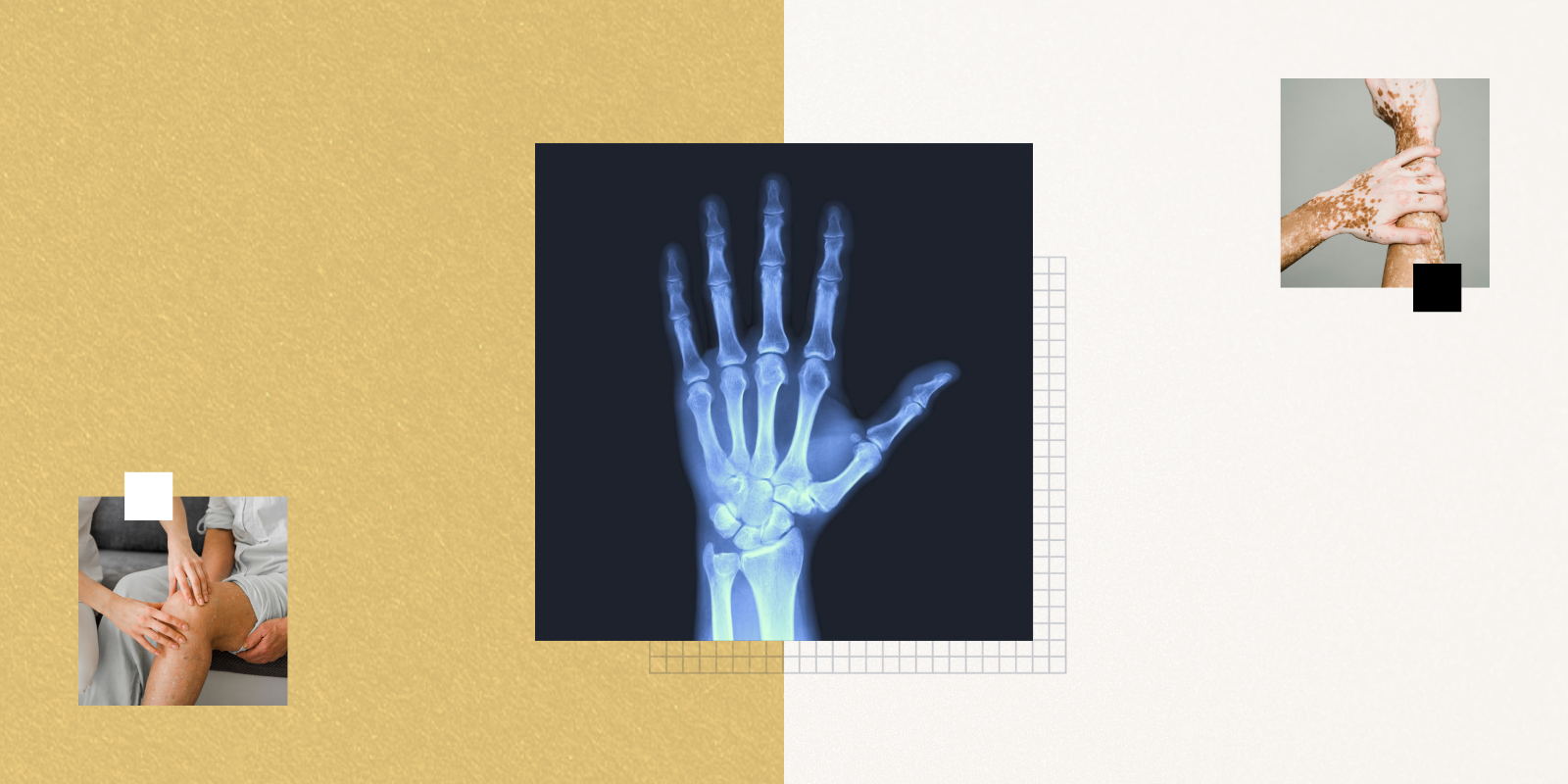 CU Anschutz Rheumatologists ‘Get Creative’ in Expanding Patients’ Access to Care